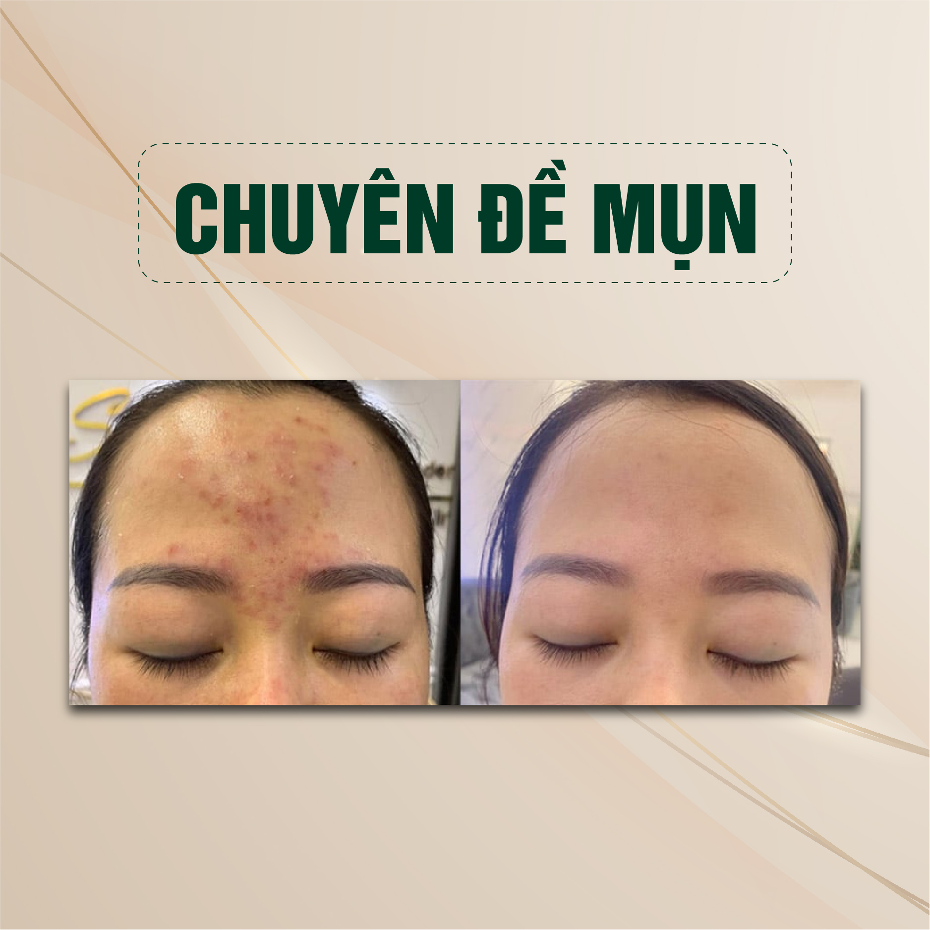 Chuyên đề mụn