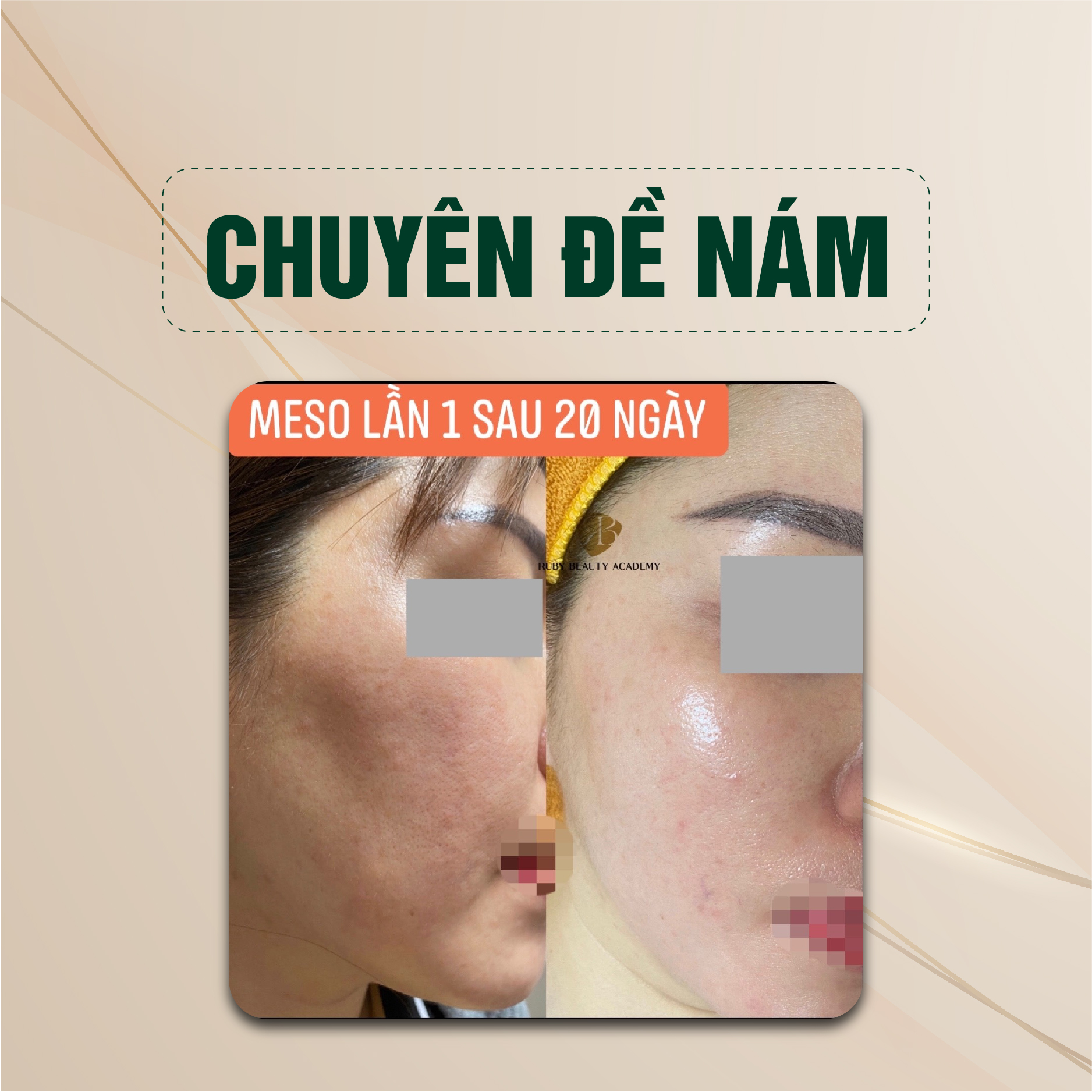 Chuyên đề lão hóa